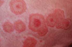 Erythema multiforme - Hình ảnh minh họa